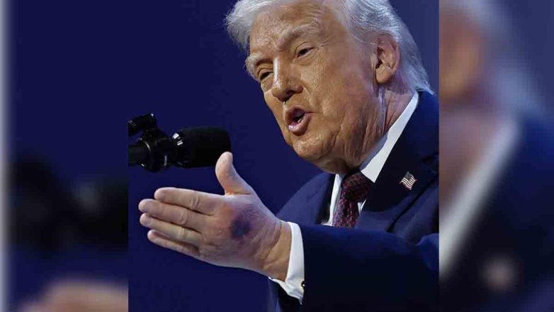 Με μελανιά στο χέρι ο Τραμπ στο Νταβός