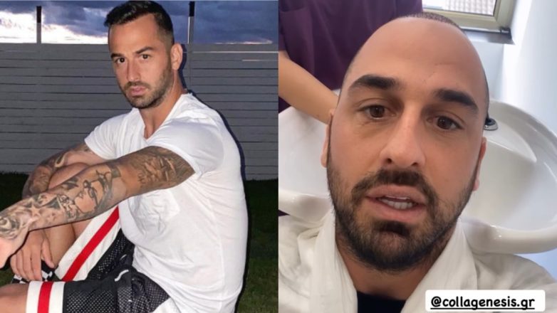 Άρης Σοϊλέδης: Έκανε μεταμόσχευση μαλλιών – Η αλλαγή στην εμφάνισή του