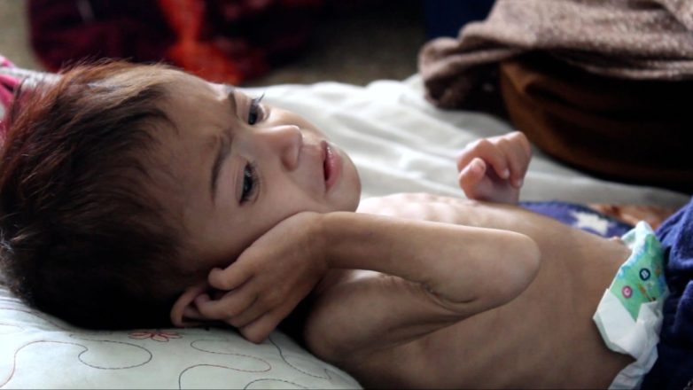 UNICEF για Αφγανιστάν: Ένα εκατομμύριο παιδιά κινδυνεύουν να πεθάνουν από υποσιτισμό