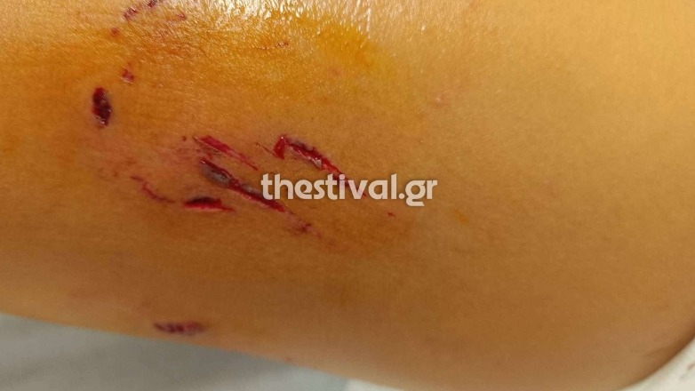 Θεσσαλονίκη: 12χρονη δέχθηκε άγρια επίθεση από αγέλη σκυλιών Θεσσαλονίκη: 12χρονη δέχθηκε άγρια επίθεση από αγέλη σκυλιών