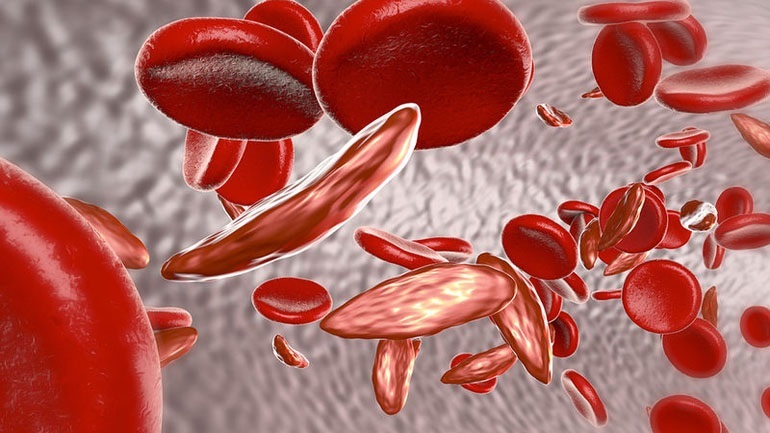 Η άσκηση μειώνει τον κίνδυνο πήξης σε ασθενείς με μη αλκοολική λιπώδη ηπατική νόσο