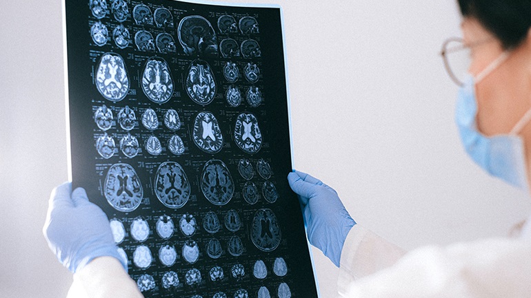 Οι παράγοντες κινδύνου εγκεφαλικού έχουν μικρότερες επιπτώσεις όσο μεγαλώνουν οι άνθρωποι