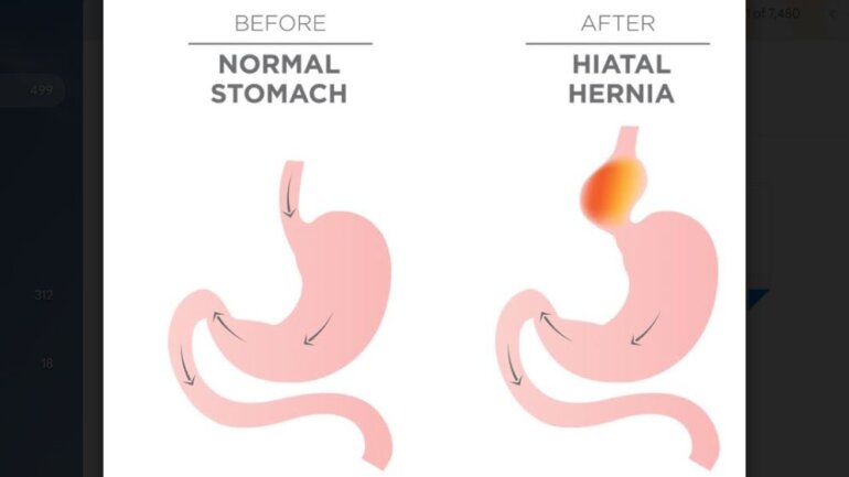 Αντιμετώπιση της διαφραγματοκήλης με ρομποτική χειρουργική 