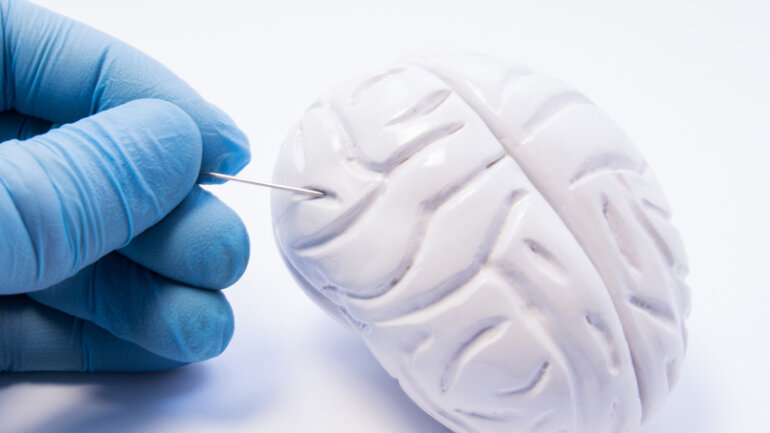 Μηνιγγίωμα εγκεφάλου: Τι είναι και πώς αντιμετωπίζεται