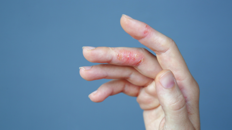 Η LEO Pharma ανακοινώνει θετικά αποτελέσματα για την κρέμα delgocitinib για το μέτριο έως σοβαρό χρόνιο έκζεμα