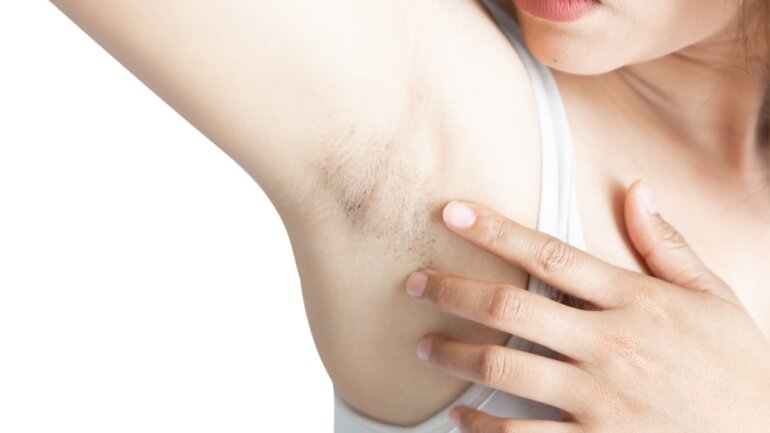 Διαπυητική ιδρωταδενίτιδα: Θετικά αποτελέσματα από την μπιμεκιζουμάμπη