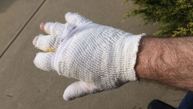 Κάρπαθος: Για δύο ευρώ τον δάγκωσε και του έκοψε το δάκτυλο