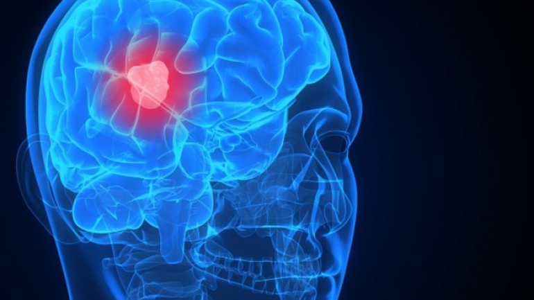 Νέο διαγνωστικό εργαλείο για τον εντοπισμό των εγκεφαλικών όγκων