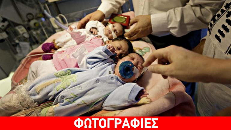 Eπιτυχημένη επέμβαση: Σιαμαία κοριτσάκια διαχωρίστηκαν σε νοσοκομείο της Ελβετίας