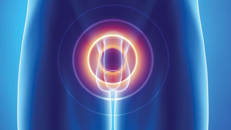 Ο δυτικός τρόπος διατροφής μπορεί να αυξήσει τον κίνδυνο θανάτου σε ασθενείς με καρκίνο του προστάτη