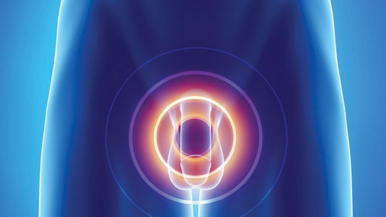 Τα φάρμακα για τη στυτική δυσλειτουργία δεν αυξάνουν τον κίνδυνο υποτροπής του καρκίνου του προστάτη