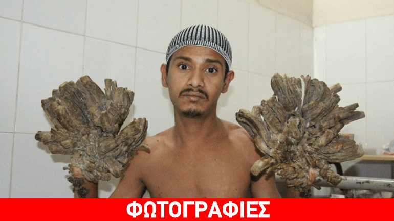 Νέα ζωή για τον άνθρωπο-δένδρο Νέα ζωή για τον άνθρωπο-δένδρο