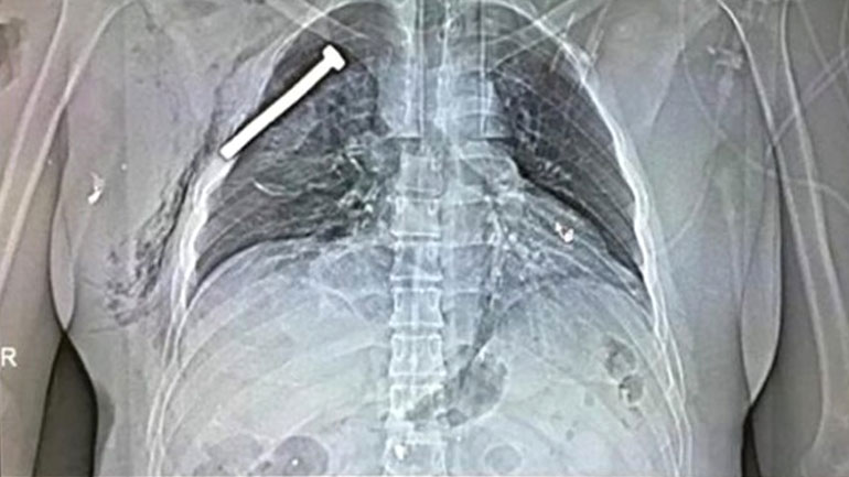 Σοκ: Βίδα στο σώμα ενός εκ των θυμάτων στις Βρυξέλλες