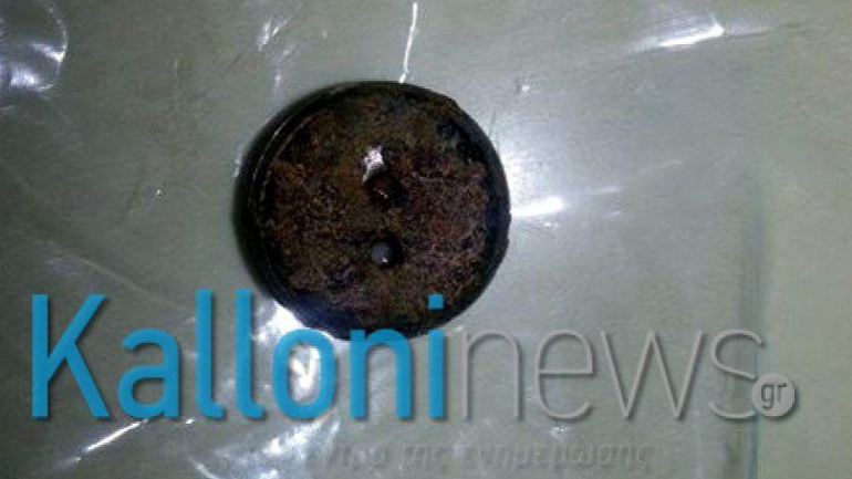 Ξέχασαν κουμπί στο πόδι του για…32 χρόνια!