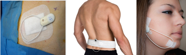 Εικόνα 1: Οι συσκευές μπορούν να χρησιμοποιηθούν πάνω από επιθέματα και πάνω από ρούχα, αλλά και για κάθε πόνο όπως της μέσης, ο οδοντιατρικός (πχ νευραλγία τριδύμου), το αυχενικό σύνδρομο κ.λ.π