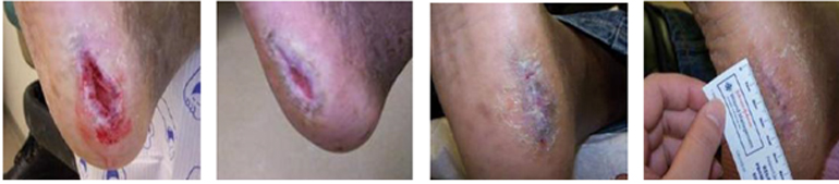 Εικόνα 2: Ταχεία αποκατάσταση έλκους άκρου ποδός μετά από 3 εβδομάδες, με χρήση PEMF μικροσυσκευής