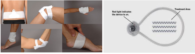 Εικόνα 3: Οι αναλώσιμες μικροσυσκευές έχουν πληθώρα εφαρμογών σε διάφορες θέσεις του σώματος. Σημαντικό είναι να παγιδεύσεις το σημείο του πόνου εντός του σχηματιζόμενου κύκλου της αναλώσιμης μικροσυσκευής