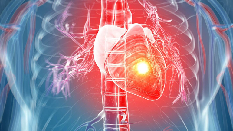 Έρευνα: Θανατηφόρα «σιωπηλά» καρδιακά εμφράγματα