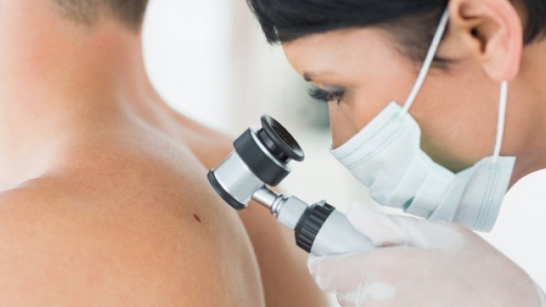 Επηρεάζει το Viagra την εξέλιξη του μελανώματος