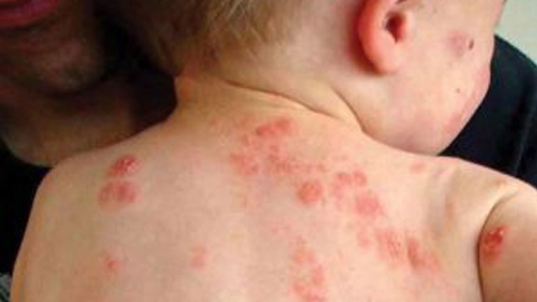 Κρούσματα ψώρας σε βρεφονηπιακό σταθμό στο Διδυμότειχο