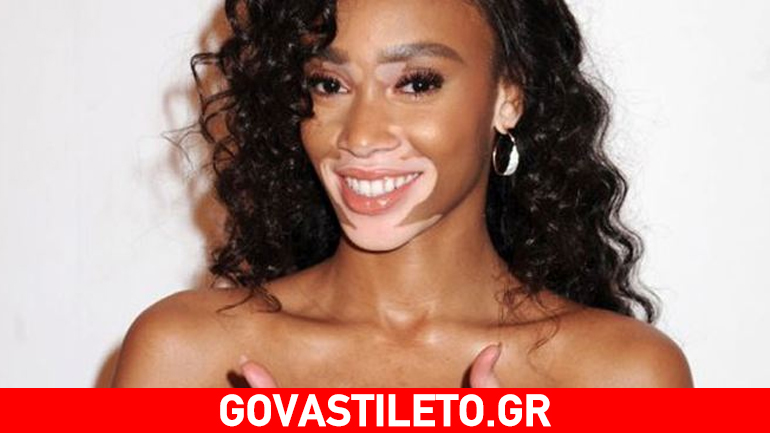 Winnie Harlow: Πόζαρε στον φακό έχοντας λέυκη και έσπασε όλα τα ταμπού του modeling