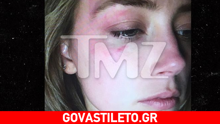 Σοκάρει η Amber Heard: Καταγγέλλει για ξυλοδαρμό τον Johnny Depp