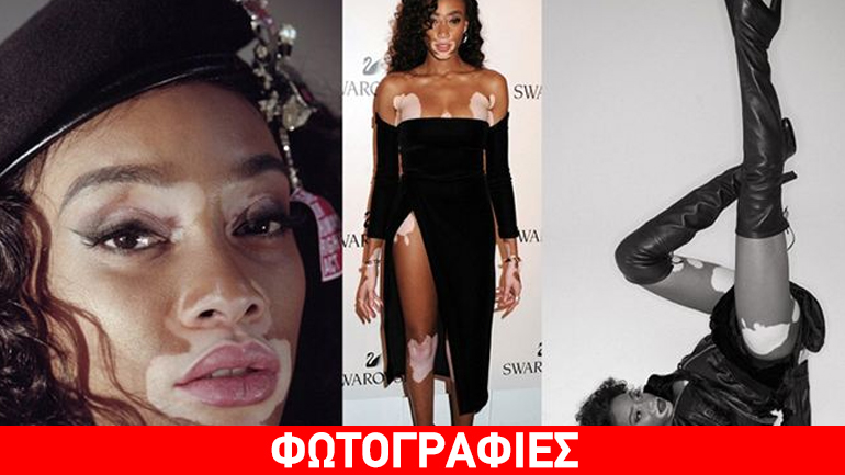 Αυτό είναι το μοντέλο με λεύκη που κατακτά τις πασαρέλες