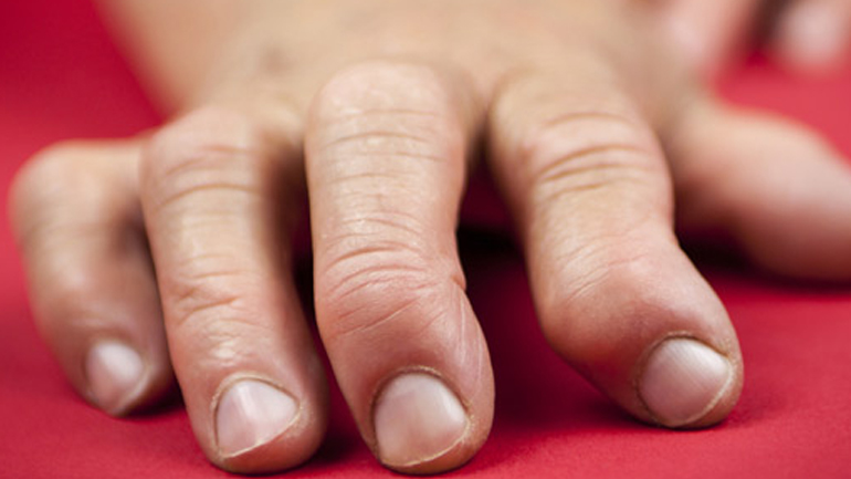 Συμβουλές για καλύτερη σεξουαλική ζωή σε ασθενείς με ρευματοειδή αρθρίτιδα