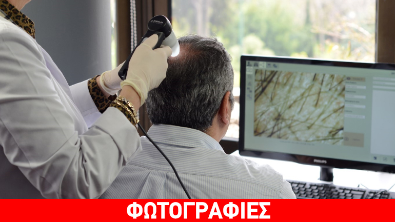 Mεταμόσχευση μαλλιών; Γιατί πρέπει να ζητάτε εγγύηση για τον αριθμό των τριχοθυλακίων που θα επαναφυτρώσουν