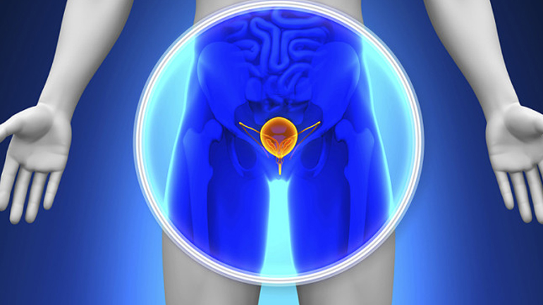 Οι άνδρες υποτιμούν την αρνητική επίδραση της ριζικής προστατεκτομής στη σεξουαλική λειτουργία