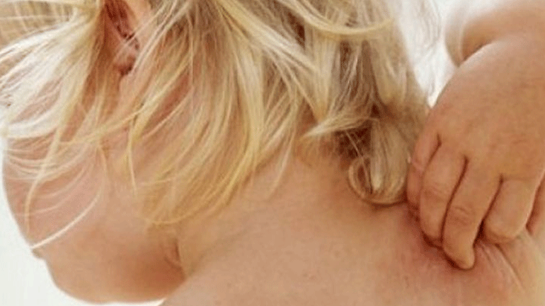 Τι είναι οι «δρωτσίλες»; Τι προκαλούν στο παιδί, πώς καταπολεμούνται