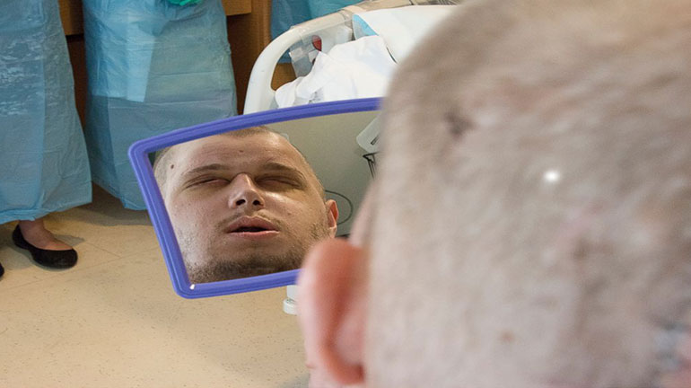 Ο πρώτος αποδέκτης μεταμόσχευσης προσώπου παγκοσμίως έχει πεθάνει