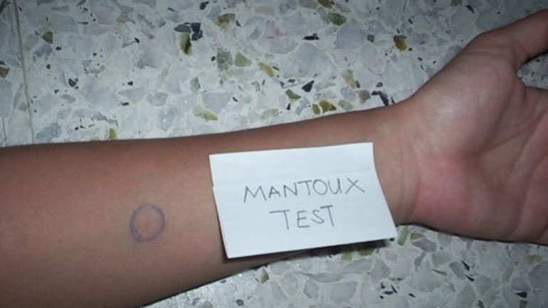 Θετικοί στην εξέταση για φυματίωση 15 εργαζόμενοι σε νοσοκομείο της Θεσσαλονίκης