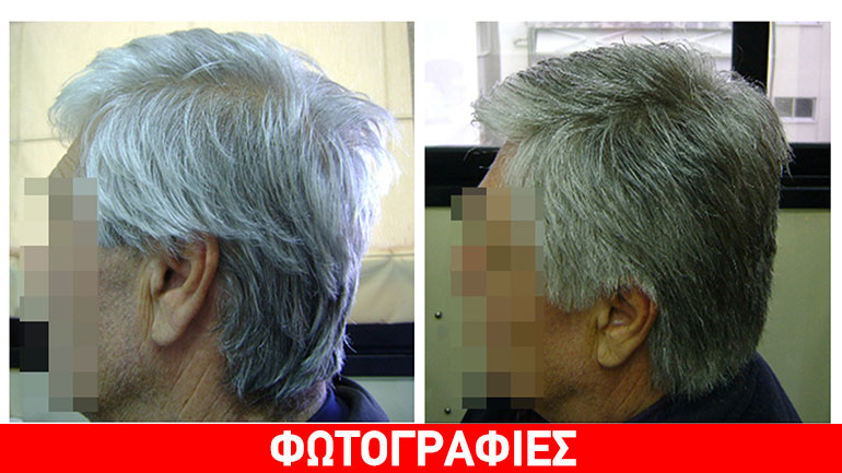 Καινοτόμος τεχνική αποκατάστασης μαλλιών HOS-2 ανεβάζει την ψυχολογία των ογκολογικών ασθενών