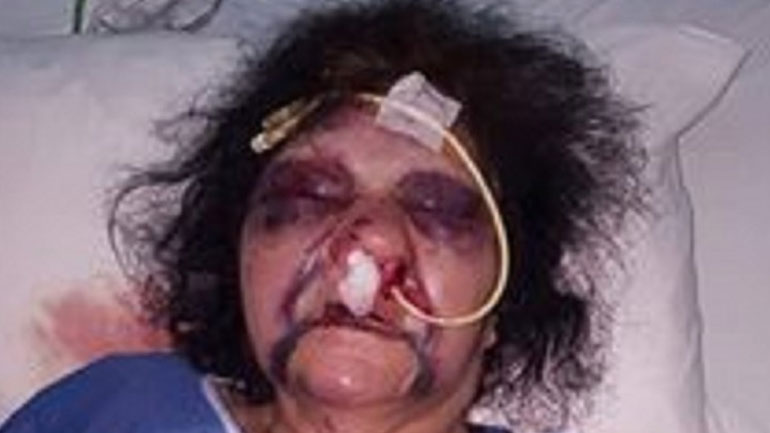 Θύμα άγριου ξυλοδαρμού ηλικιωμένη στη Ρόδο