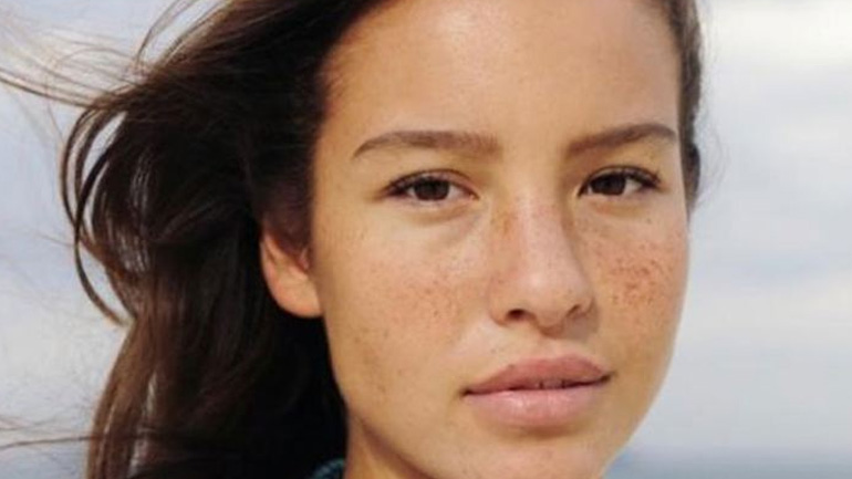 Εξαφανίστε τις φακίδες σας