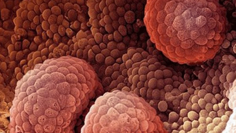 Ο καρκίνος του προστάτη και οι μεταλλάξεις στο DNA