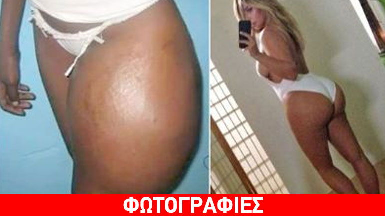 Έβαλε εμφυτεύματα για να μοιάσει στην Καρντάσιαν, αλλά…