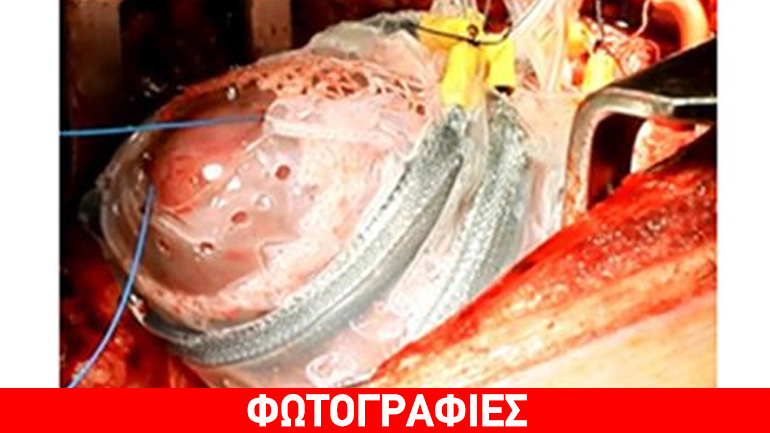 Δημιουργήθηκε το πρώτο μαλακό ρομπότ που «αγκαλιάζει» την καρδιά και τη βοηθά να χτυπά