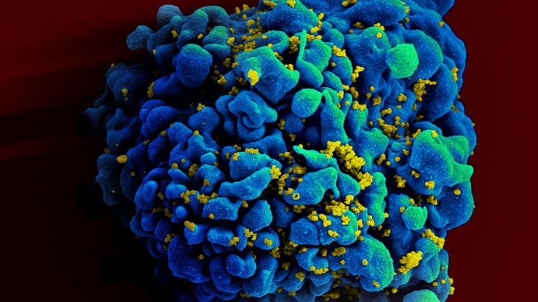 Ελπίδες για ενισχυμένη θεραπεία του ιού HIV από έρευνα με επικεφαλής έναν Έλληνα επιστήμονα στις ΗΠΑ
