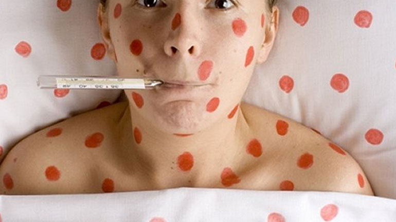 Συναγερμός για νέα έξαρση της ιλαράς