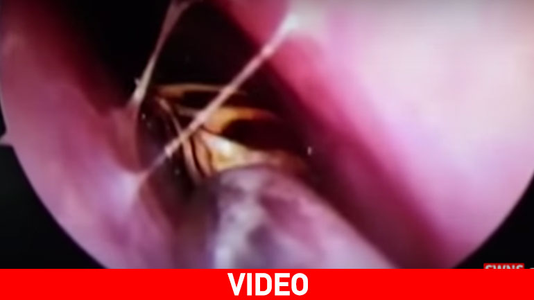 Αφαίρεσαν ζωντανή κατσαρίδα μέσα από το κρανίο 42χρονης