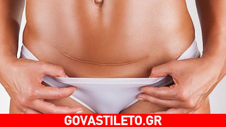 Τα υπέρ και τα κατά της καισαρικής τομής