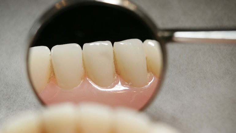 Η περιοδοντίτιδα συνδέεται με αυξημένο κίνδυνο εγκεφαλικού και διαβήτη