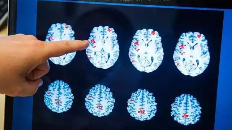 Έρευνα: Εντοπίσθηκε γονίδιο που γερνάει απότομα τον εγκέφαλο ενός ανθρώπου