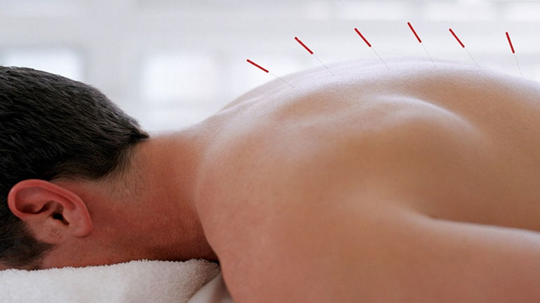 Ο βελονισμός ως εναλλακτική θεραπεία της στυτικής δυσλειτουργίας