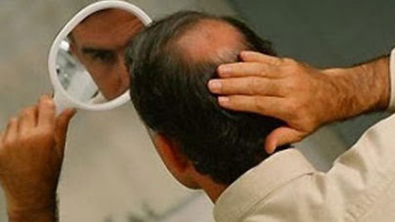 Η απώλεια μαλλιών στους άνδρες συνδέεται με γονίδια που κληρονομούν από τις μητέρες τους