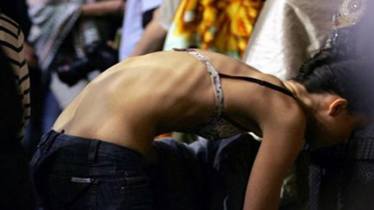 Γαλλία: Σχεδόν η μία έφηβη στις πέντε είναι υπερβολικά αδύνατη