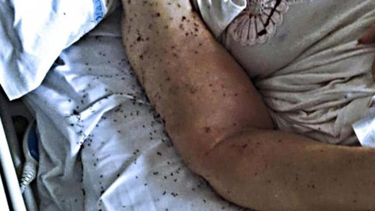 Ηλικιωμένη γυναίκα εγκαταλείφθηκε σε κλίνη νοσοκομείου της Νάπολης γεμάτη μυρμήγκια