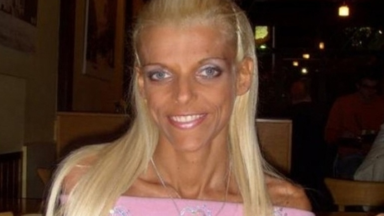 Νανά Καραγιάννη: Η πολύχρονη μάχη με την νευρική ανορεξία